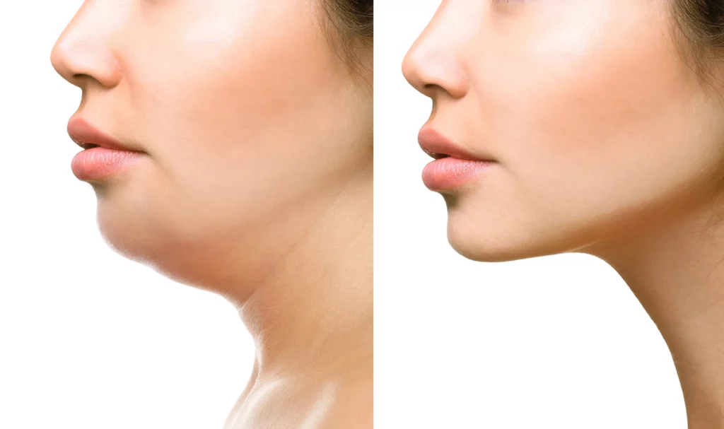 Kybella Treatment in Yuma, AZ | Yuma Wellness & Aesthetics