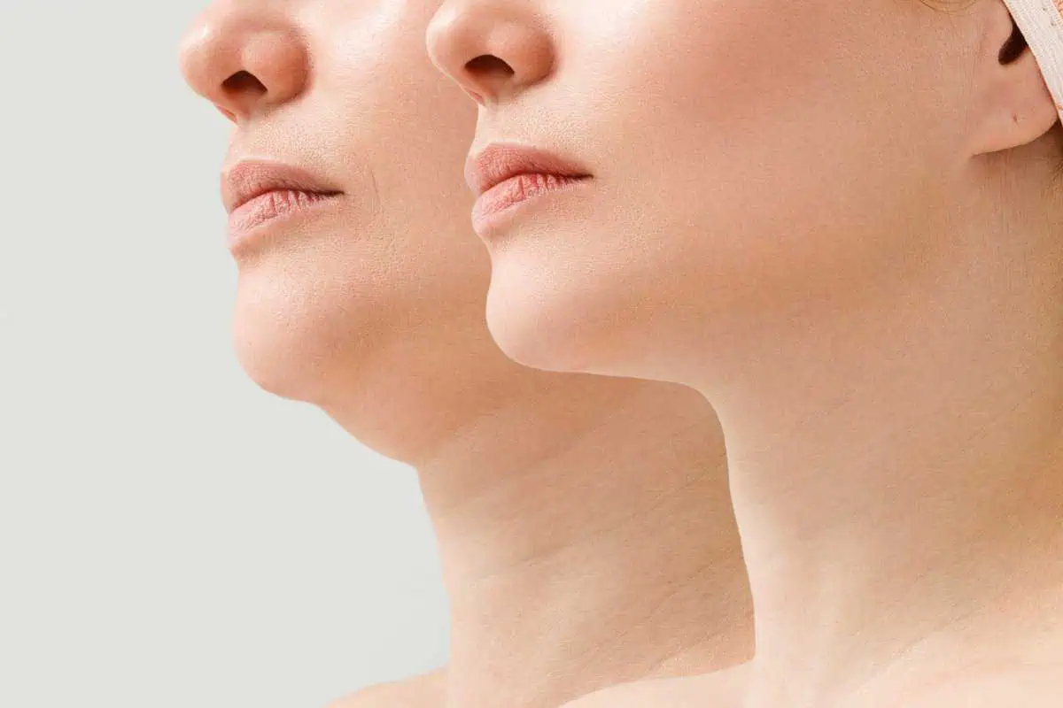 Kybella Treatment in Yuma, AZ | Yuma Wellness & Aesthetics