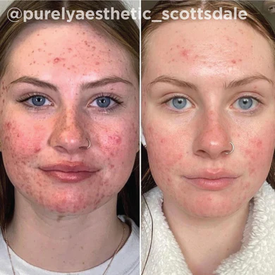 Chemical Peels Treatment Before and After Image | Yuma, Arizona