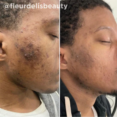 Before and after results of a cosmetic treatment showing skin improvement, featured by Yuma Wellness Aesthetics