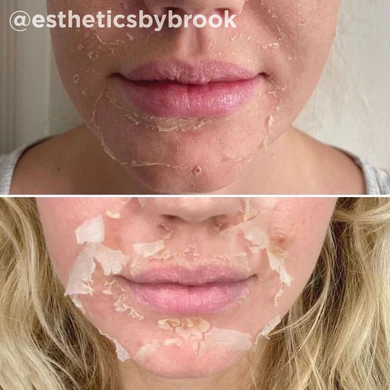 Chemical Peels Before and After Image of a Girl at Yuma Wellness and Aesthetics