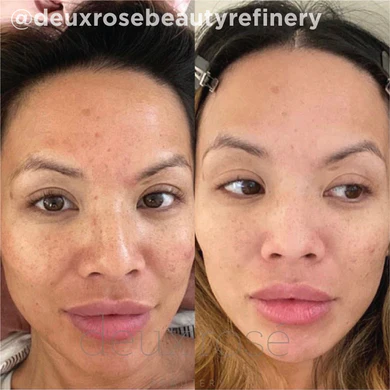 Skin Rejuvenation Before and After Gallery | Yuma, AZ