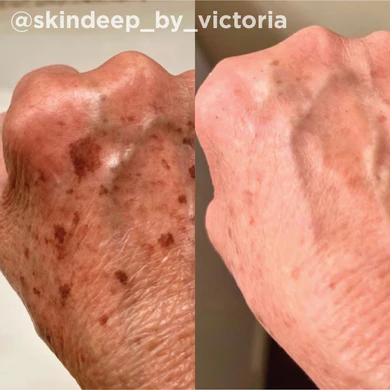 Before and After Hand Rejuvenation Gallery | Yuma Wellness and Aesthetics in Yuma, AZ