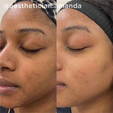 Skin Treatment Before and After Image | Yuma Wellness and Aesthetics in Yuma, AZ