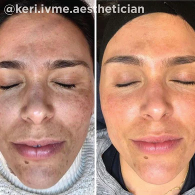 Skin Treatment Before and After Gallery | Yuma Wellness and Aesthetics in Yuma, AZ