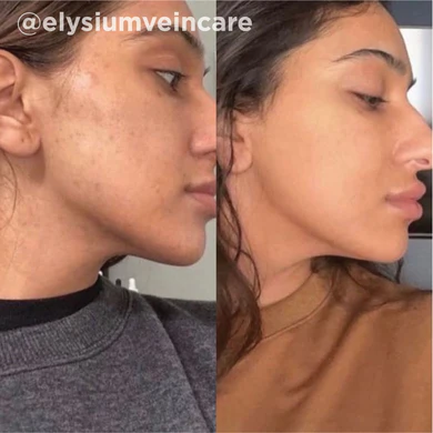 Before and After Aesthetic Treatment Image of A Girl | Yuma Wellness and Aesthetics