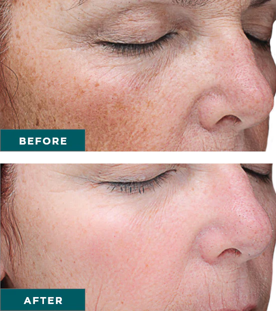 Chemical Peels Before and After Treatment Image | Yuma, Arizona