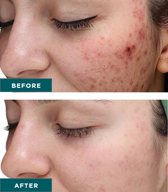 Skin Treatment Before and After Image | Yuma Wellness and Aesthetics in Yuma, AZ