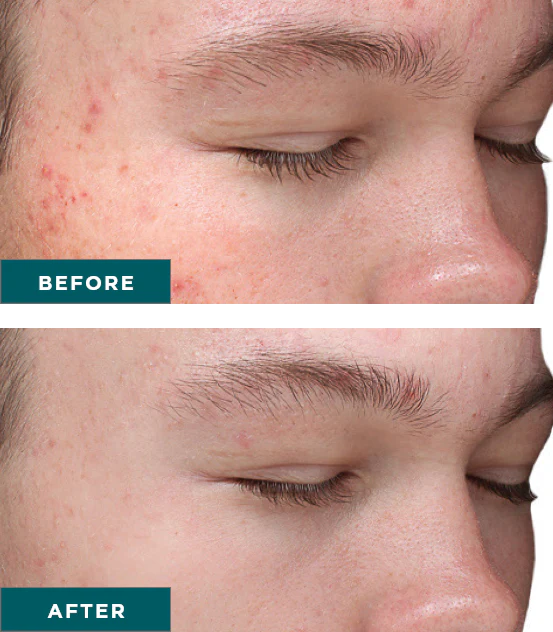 Chemical Peels Before and After Image | Yuma Wellness and Aesthetics in Yuma, AZ