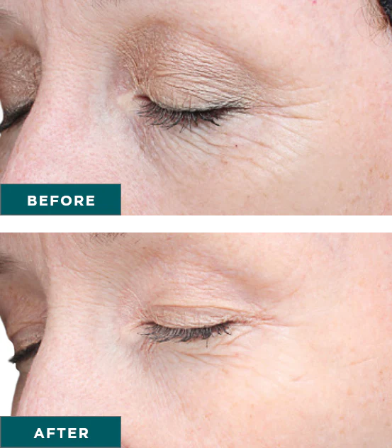 Chemical Peels Before and After Image | Yuma Wellness and Aesthetics in Yuma, AZ