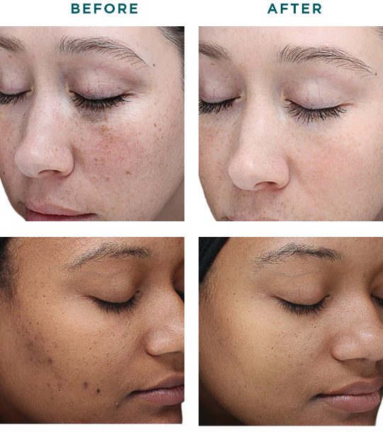 Chemical Peels Before and After Gallery | Transformation of a Woman | Yuma, AZ